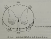 脊髓灰质炎的症状,从前驱期到瘫痪期的演变